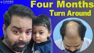 Hair Transplantation Result in 4 Months, @Eugenix by Expert Hair Restoration Surgeons