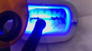 Zoom Instant Laser Teeth Whitening | How It Works | London | Whites Dental