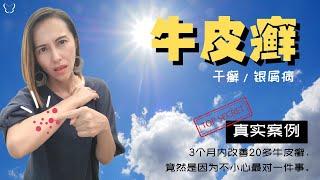 干癣 / 牛皮癣 / 银屑病真实案例: 3个月内改善20多牛皮癣，竟然是因为不小心最对一件事。。。| 20-Year Psoriasis Issue Improved Within 3 Months