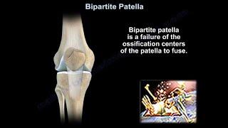 Bipartite Patella - Everything You Need To Know - Dr. Nabil Ebraheim