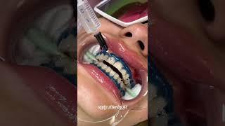 teeth whitening process  #teethwhitening#teethwhiteningprocedure