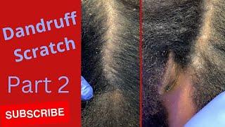 Dandruff Scratch | Stubborn Flakes |  spotty Part 2