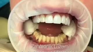 Zahnklinik Luzern - Dr.Dr.Rosanna Himmelfarb - Lumineers & Veneers