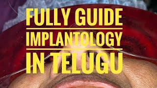 Fully guided implantology in Telugu || Dr. Samuel Simpsy || Latha’s Dentist and Dontist