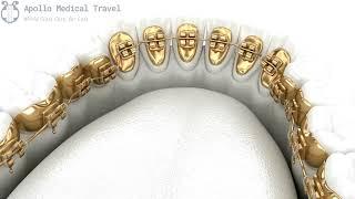 Animated Lingual Braces | Apollo Medical Travel