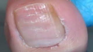 It is really easy to clean the ingrown nail【Nail Warrior】