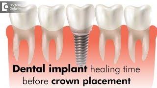 Dental implant healing time before crown placement - Dr. Sudhakara Reddy