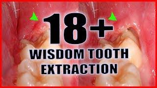 WISDOM TOOTH EXTRACTION!! +18 !!