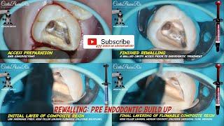 rewalling pre endodontic build up ESTELITE FLOW QUICK tokuyama plastic matrix maxillary molar