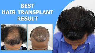 Best Hair Transplant Result || 4000+ Grafts || NW-5 Grade Baldness || Hairfree Hairgrow Clinic Surat