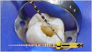 WaveOne Gold® Small Canals Technique with Dr. Willy Pertot | DENTSPLY