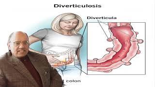 Diverticulitis