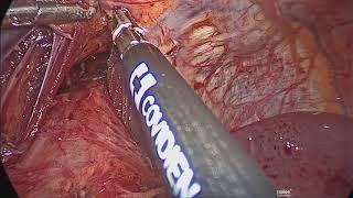 Dr. Ayman Soliman: Laparoscopic Management of Thoracic Esophageal Perforation During LSG