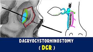 Dacryocystorhinostomy | DCR surgery|