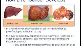 TREATMENT OPTIONS FOR LIVER CANCER by Dr. Robert Gish