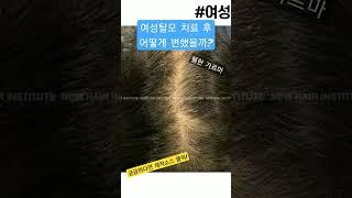 #여성탈모 휑한 가르마에 효과적인 탈모치료는?