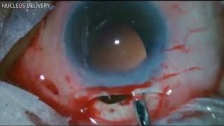 AIOC2024 - VT4 - Prof. Dr. Shalini Kumari - Red flags in manual small incision cataract surgery ...