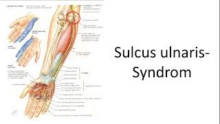 Sulcus ulnaris Syndrom