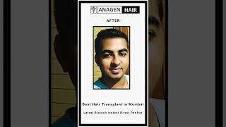 Best Hair Transplant Results in Mumbai #shorts #viralshorts