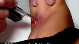 EPILATION LASER