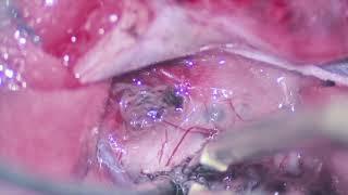 Microsurgical resection of a large  cavernous malformation of the medulla oblongata