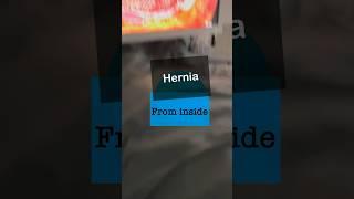 Hernia from inside ? Laparoscopic Inguinal Hernia Treatment in India I Surat I Gujarat I Mumbai