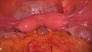 didelphys uterus ( double uterus )