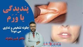 پندیدگی یا ورم چه عوامل دارد و چگونه تداوی می شود؟| داکتر قیس نیکزاد