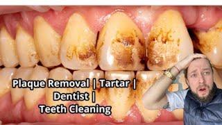 Plaque Removal | Tartar | Dentist | Teeth Cleaning  | Scaling #dentist #dentistry #dental #teeth