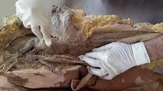 DISSECTION OF GLUTEAL REGION AND BACK OF THIGH BY DR MITESH DAVE
