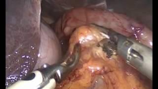 Laparascopic removal of ectopic pancreas