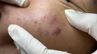 Acne treatment for Spa Linh Mun 2024 #74