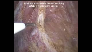 Laparoscopic hysterectomy in a lady with morbid obesity