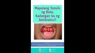 Mapulang Tonsils ng Bata: Kailangan ba ng Antibiotics?