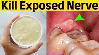 Kill Tooth Pain Nerve In LITERALLY 3 Seconds Permanently - Kill Exposed Nerve In Tooth