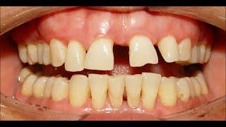 Orthodontic Treatment of Severe Median Diastema, Ekhlas 37yrs