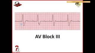Ekg Podcast 25 of 59. AV Blokády. 2. Časť