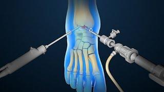 Ankle Scope | Arthroscopy | Nucleus Health