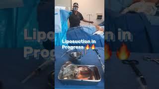 Liposuction in progress By Dr.Bucio #plasticsurgery #lipo #liposuction #sandiego #tijuana #lipo360