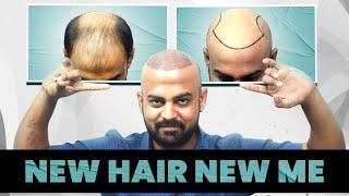 Hair Transplant Surgery Reverses Grade 5 Baldness  | Best Clinic in Kolkata | New Roots