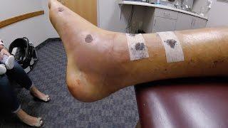 BANDAGES REMOVED AFTER SURGERY - BROKEN LEG UPDATE - KINDA GROSS