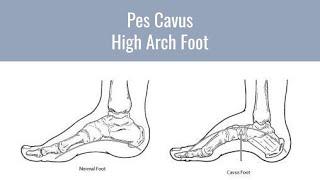 The Best Ways to Take Care of High Arch Feet