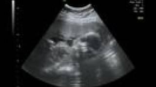 Life in the Womb III: 22 weeks ultrasound