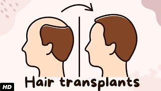 Hair transplants: Everything You Need To Know