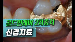 충치치료 골드인레이 2차 충치 신경치료/치아기둥세우기/크라운씌우기