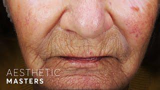 Laser Resurfacing for Deep Wrinkles - CO2 Laser