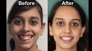 BRACES | before and after | BEST SMILE TRANSFORMATION | Gummy smile | smile design | mini implants