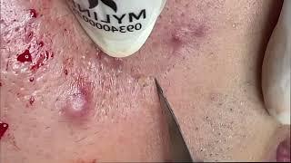 만족스러운 뾰루지 팝과 블랙헤드 제거 | Satisfying Pimple pop and Blackheads Removal