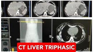 CT Liver Triphasic Scan.