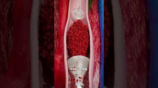 Removing Blood Clots with Vacuum 